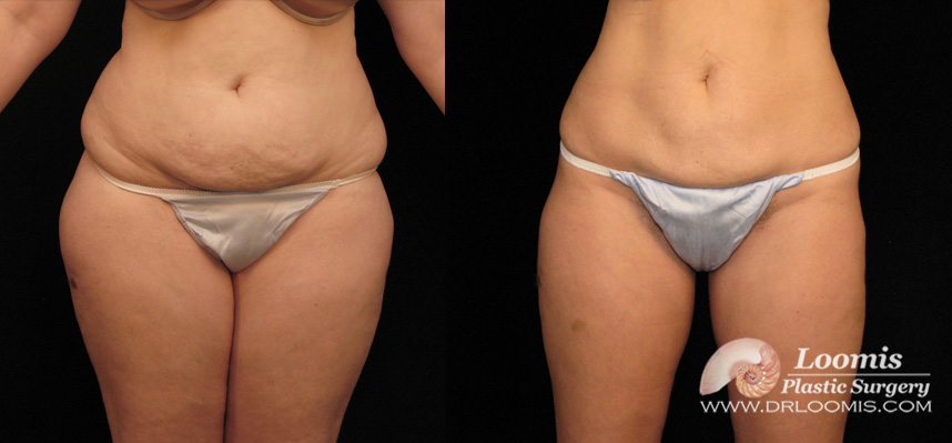 Body sculpting without surgery