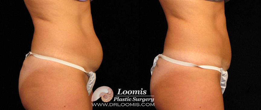 CoolSculpting® results