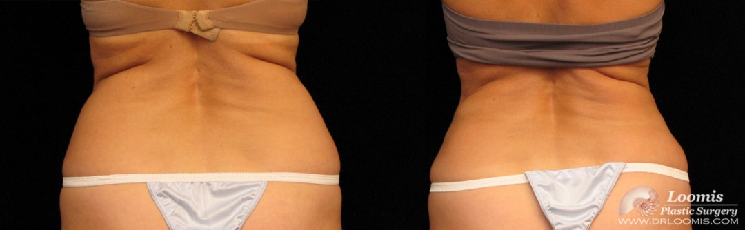 Waist sculpting without surgery