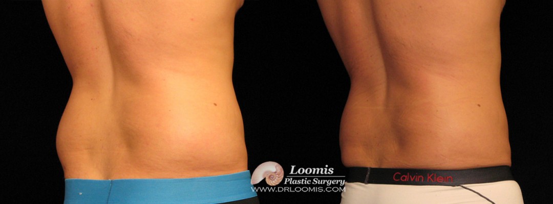 Fat freezing in men