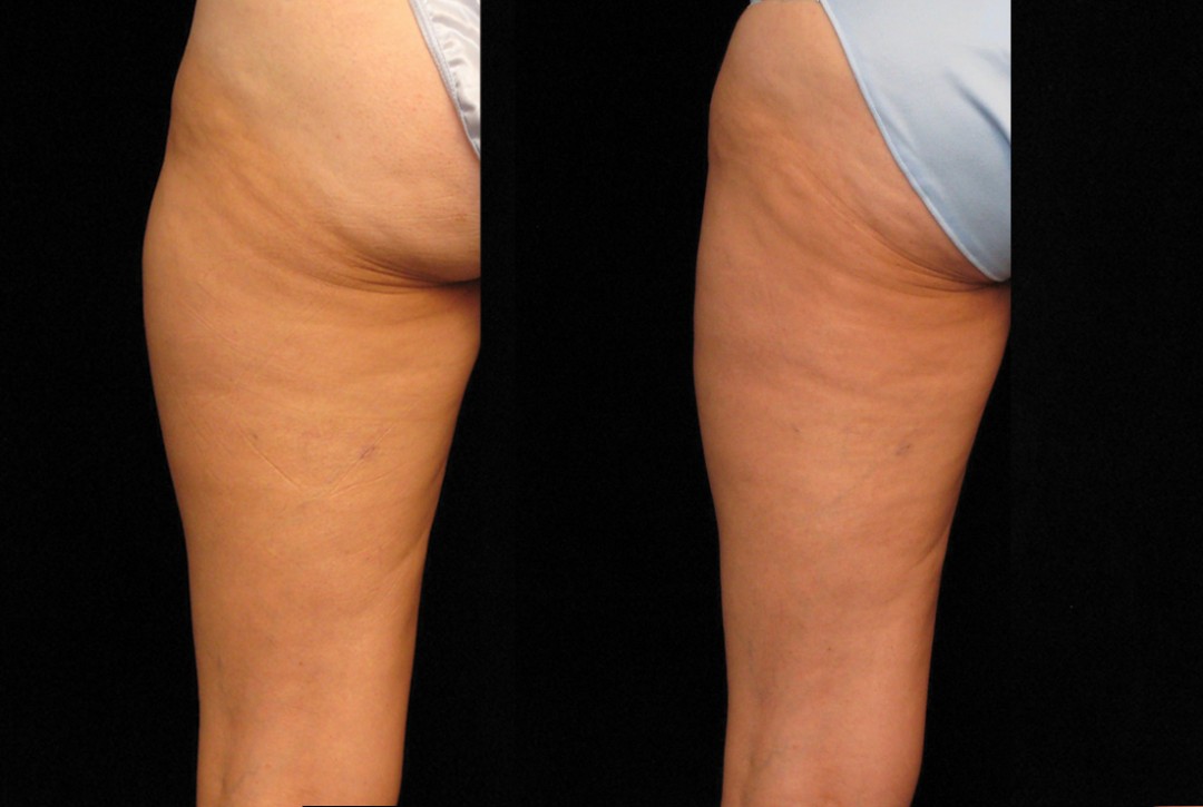 Outer thigh fat reduction