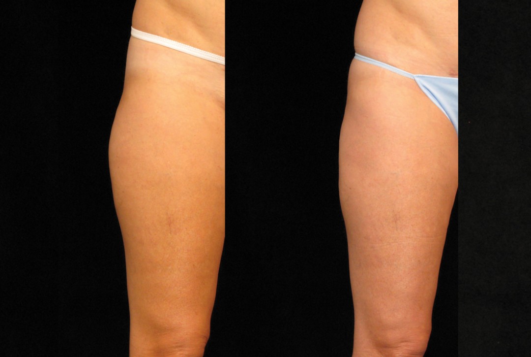 Outer thigh fat freezing