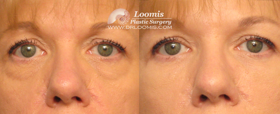 Liquid Eye Lift by Dr. Loomis (not a guarantee of results)