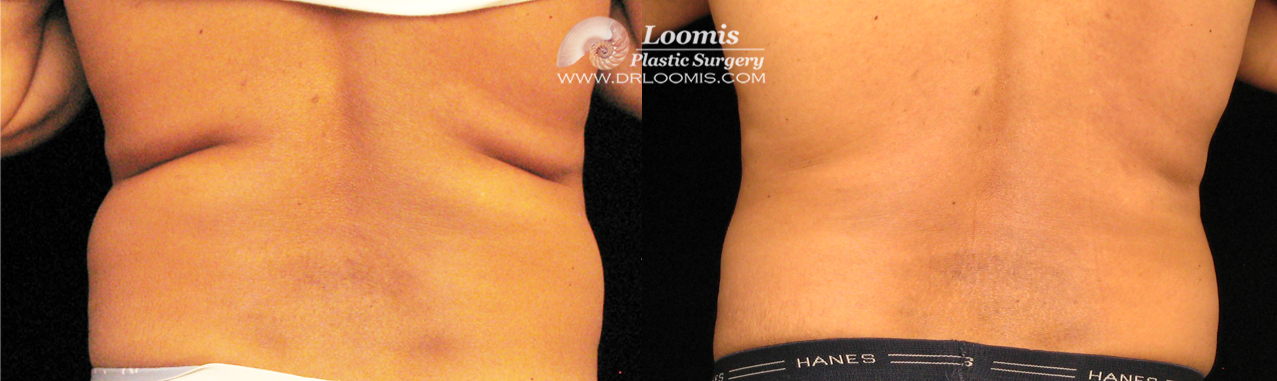 CoolSculpting® of waist