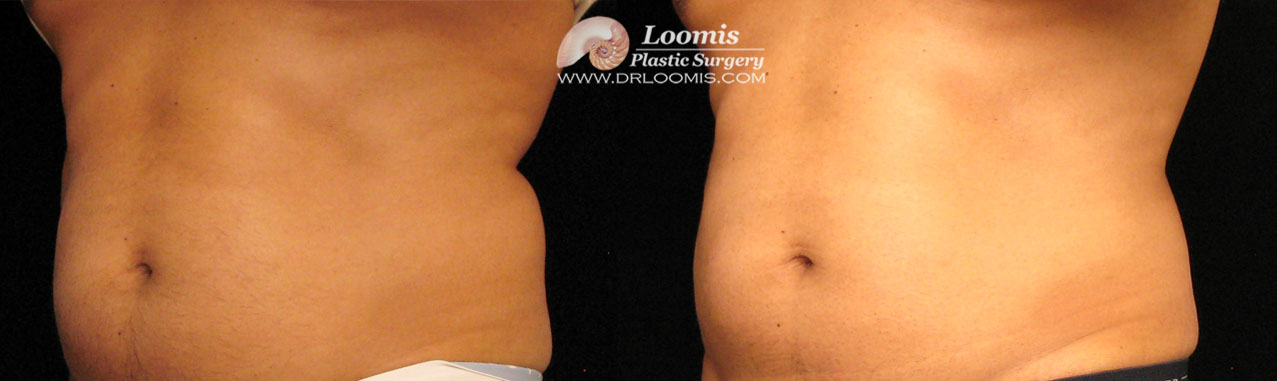 CoolSculpting® male waist