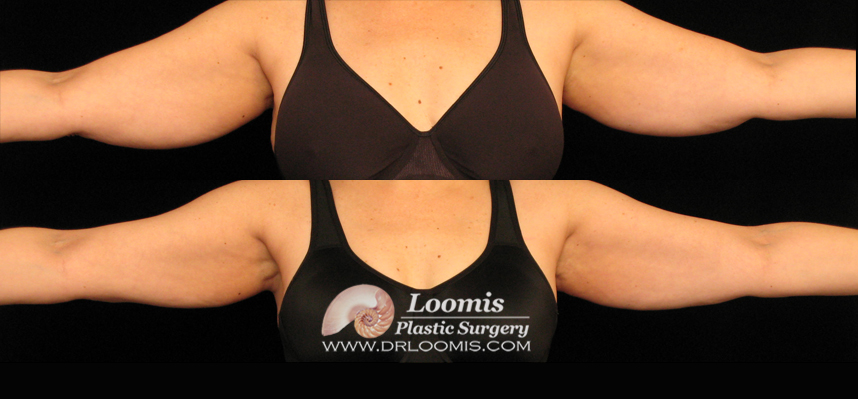 Arm CoolSculpting