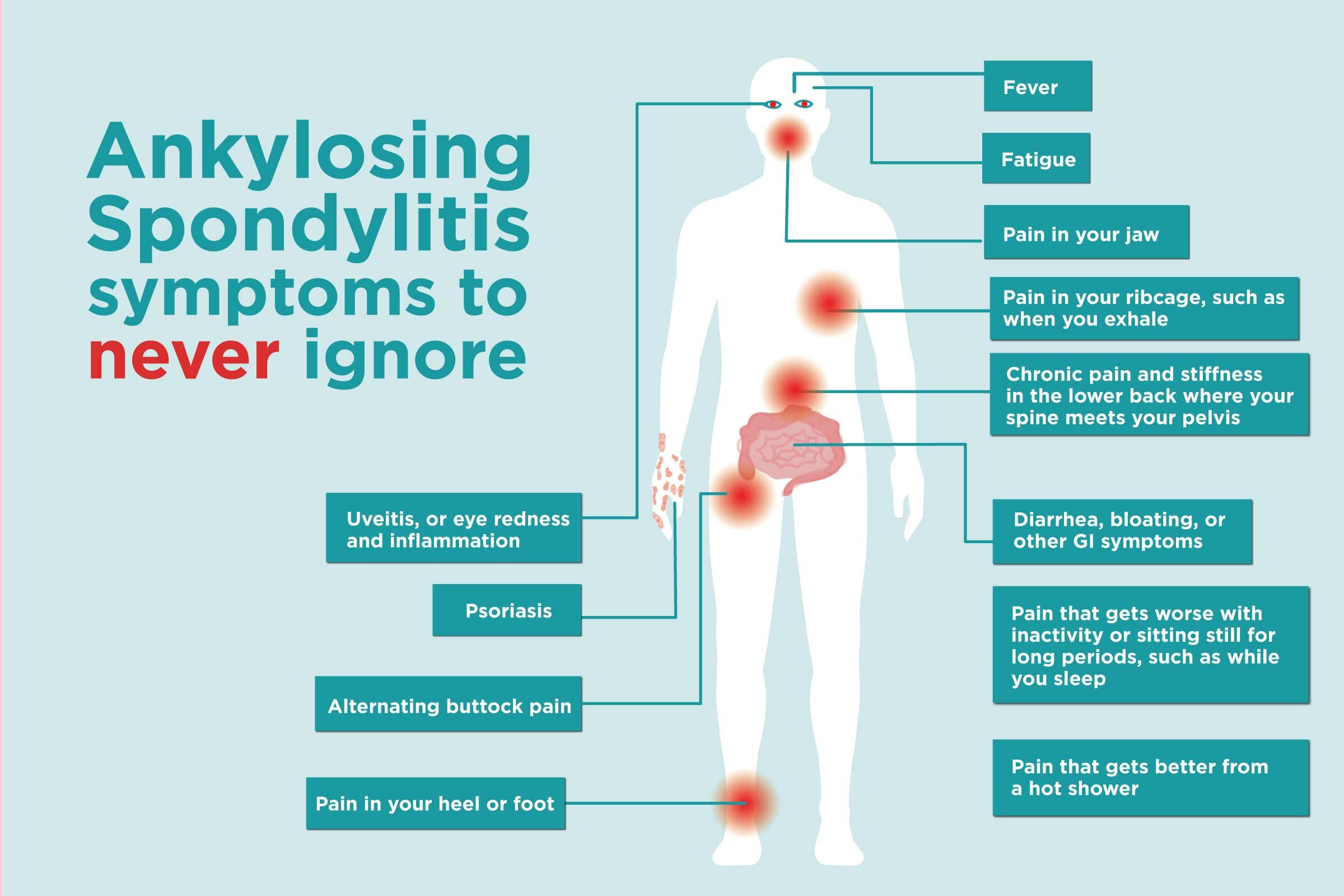 Ankylosing Spondylitis Chiswick Physio ankylosing-spondylitis-chiswick-physio