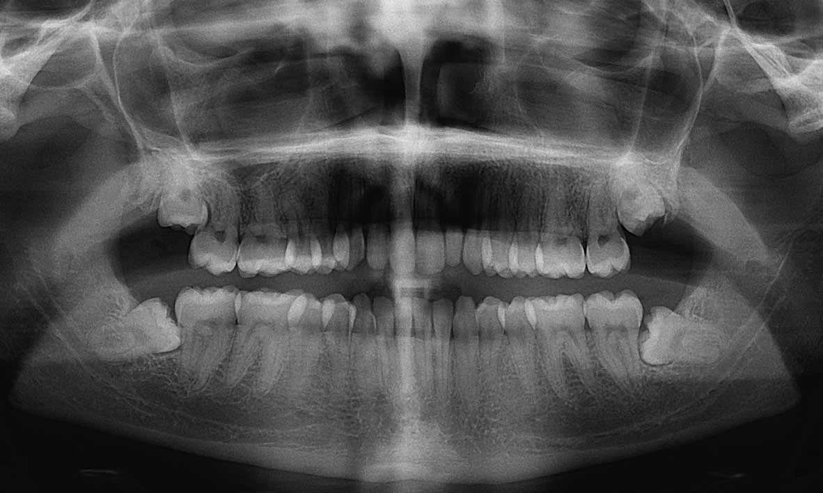 How Much Does a Wisdom Tooth Extraction Cost?