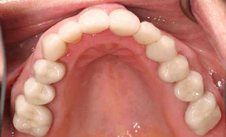Emergency-Dentist-Sydney-05-White-Fillings.jpg