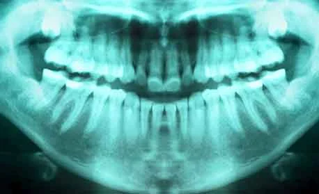 Emergency-Dentist-Sydney-02-damaged-and-broken-teeth.jpg