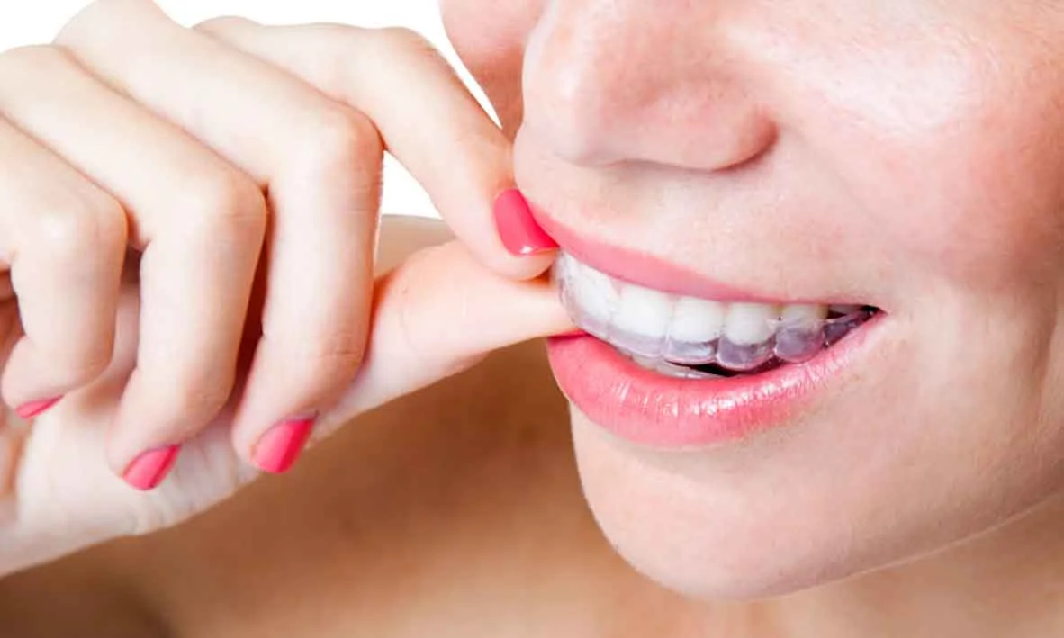 Hot New Trend: Braces for Adults 