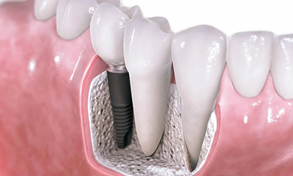 Dental implants have become a popular treatment.