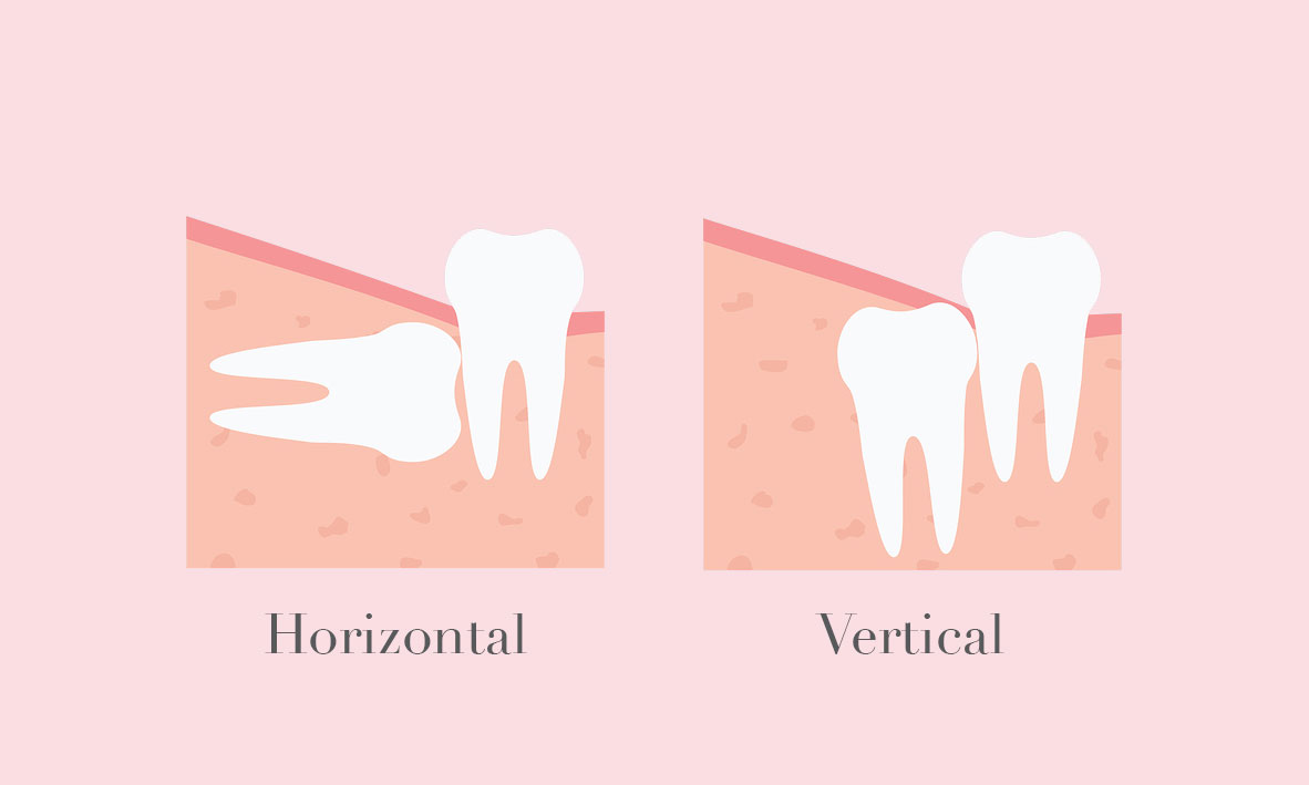 © Emergency Dentist Sydney The Evolution of Wisdom Teeth 05.jpg