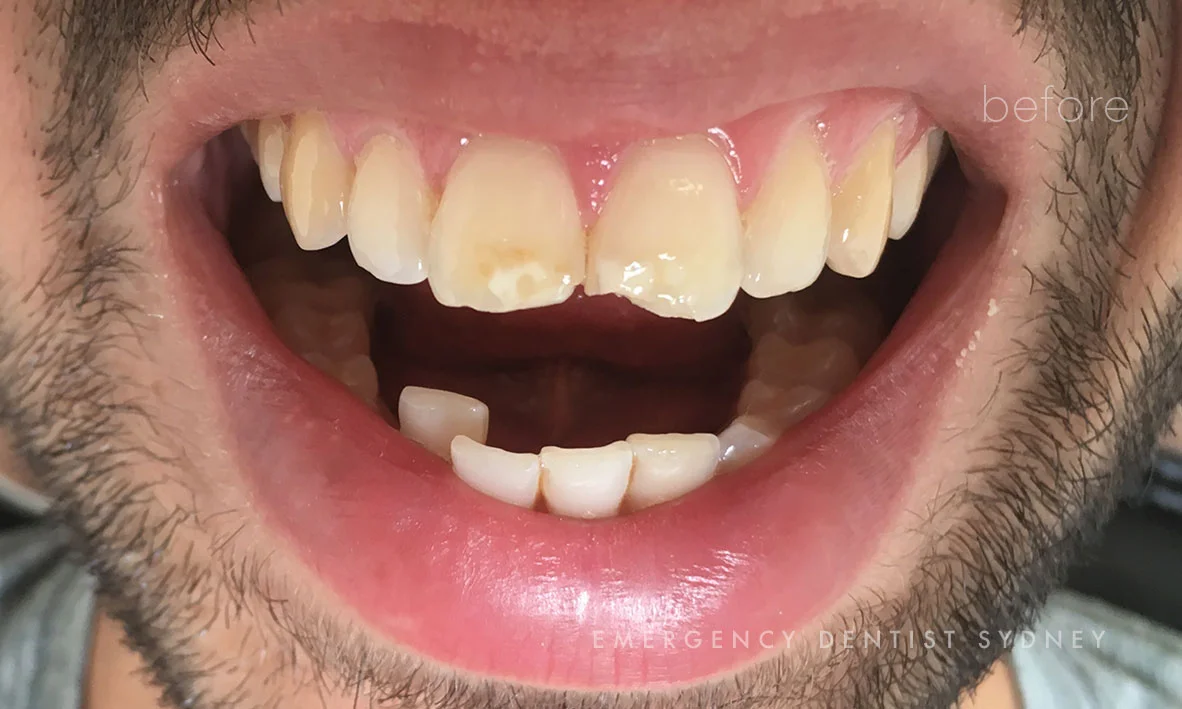 Chipped teeth treated with Composite bonding