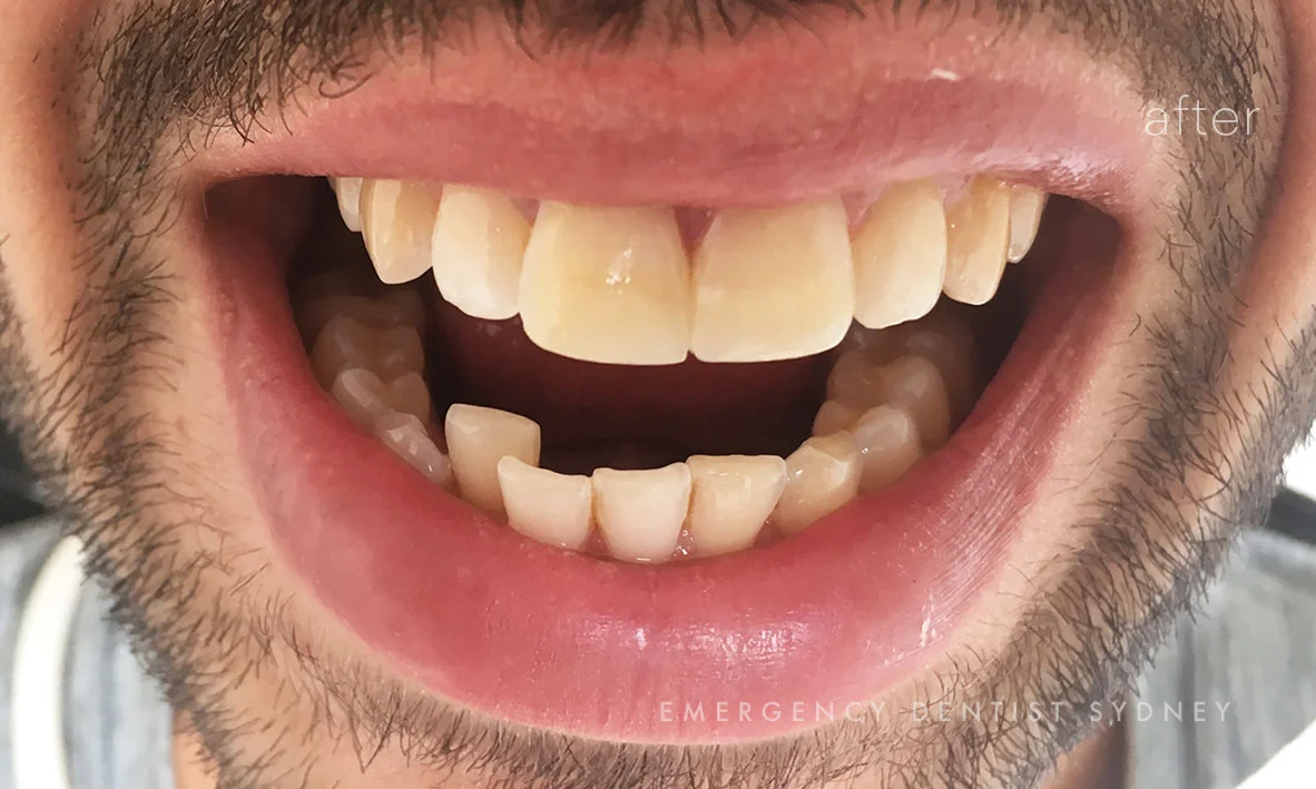 Chipped teeth treated with Composite bonding
