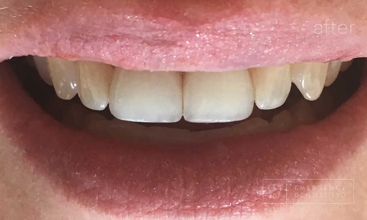 Treatment: Dental bonding and crowns to restore front teeth