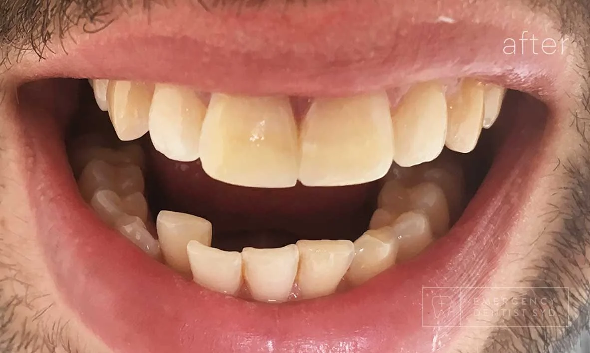 Treatment: Composite Bonding