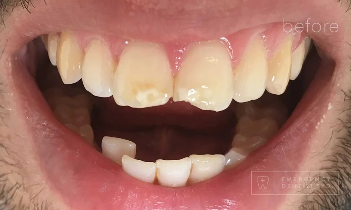 Treatment: Composite bonding