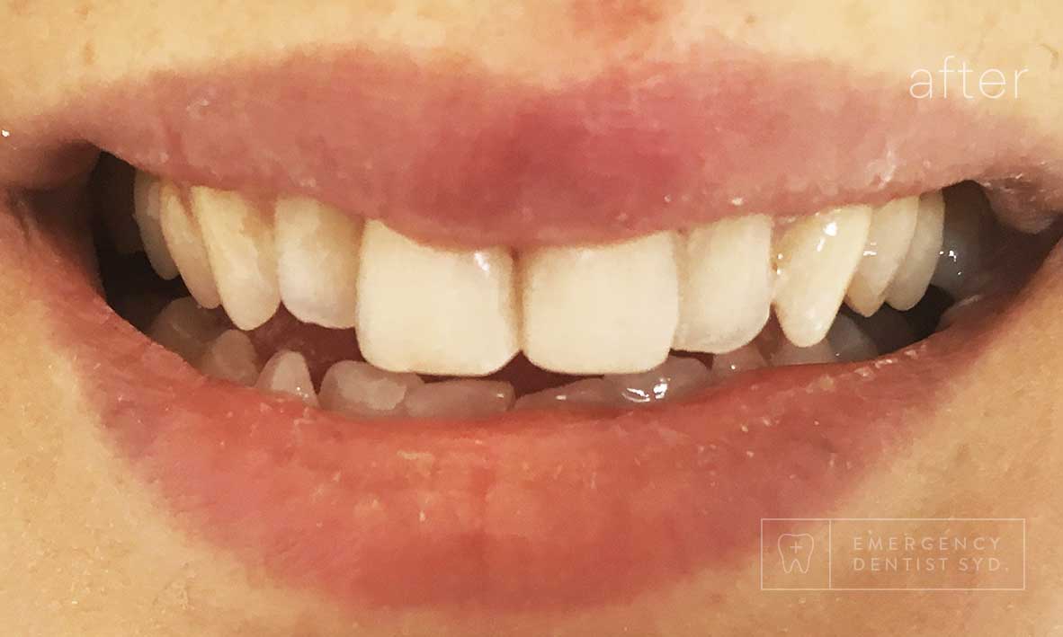 © Emergency Dentist Sydney Smile Gallery Before and After Teeth 1-after.jpg