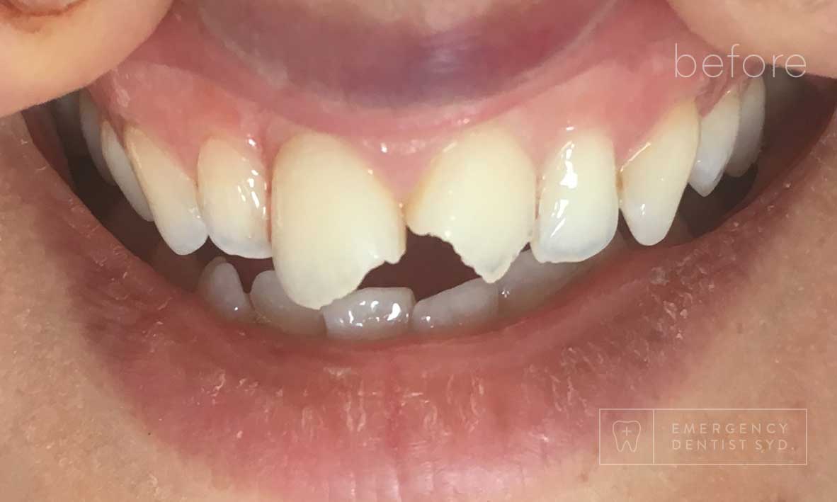 © Emergency Dentist Sydney Smile Gallery Before and After Teeth 1-before.jpg