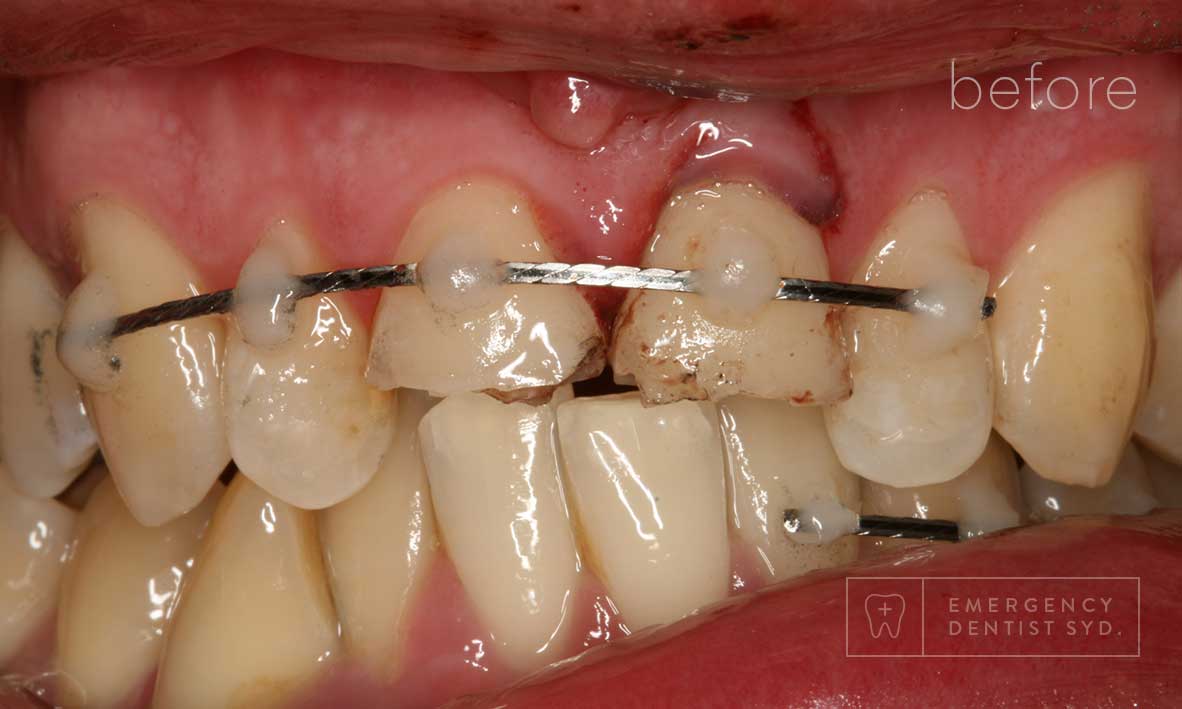 © Emergency Dentist Sydney Smile Gallery Before and After Teeth 4-before.jpg