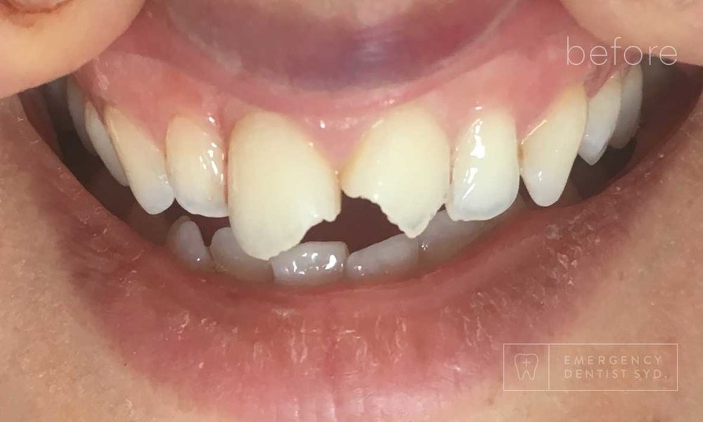 Fix Broken Tooth Perth  Same Day Emergency Appointment