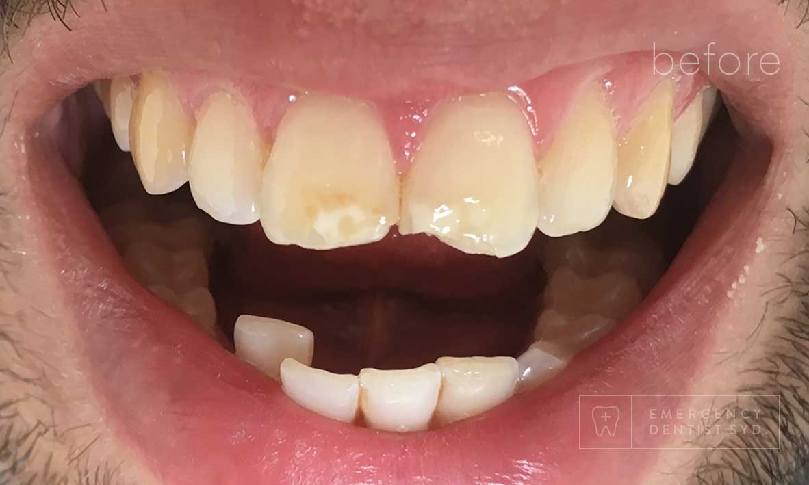 © Emergency Dentist Sydney Smile Gallery Before and After Teeth 2-before.jpg