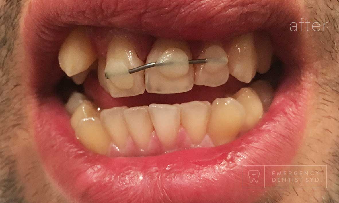 © Emergency Dentist Sydney Smile Gallery Before and After Teeth 3-after.jpg