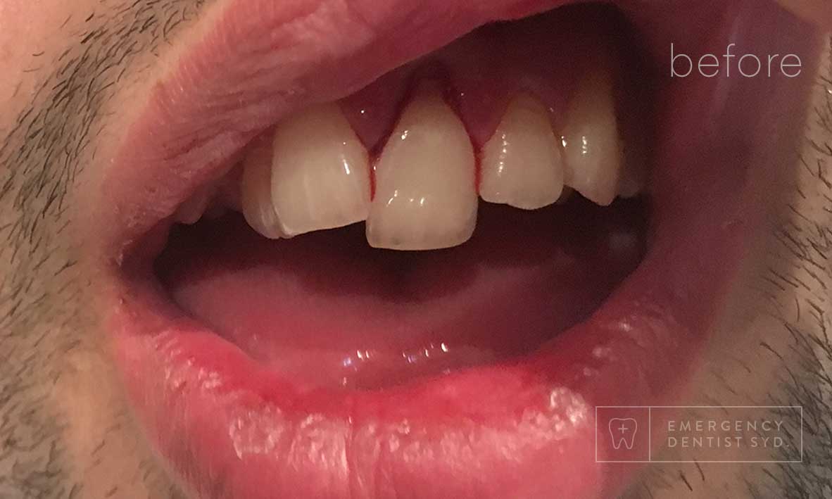 © Emergency Dentist Sydney Smile Gallery Before and After Teeth 3-before.jpg