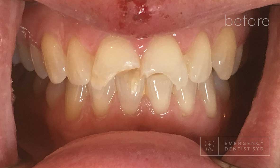 © Emergency Dentist Sydney Smile Gallery Before and After Teeth 5-before.jpg