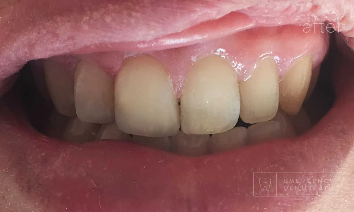 Treatment: Dental Bonding