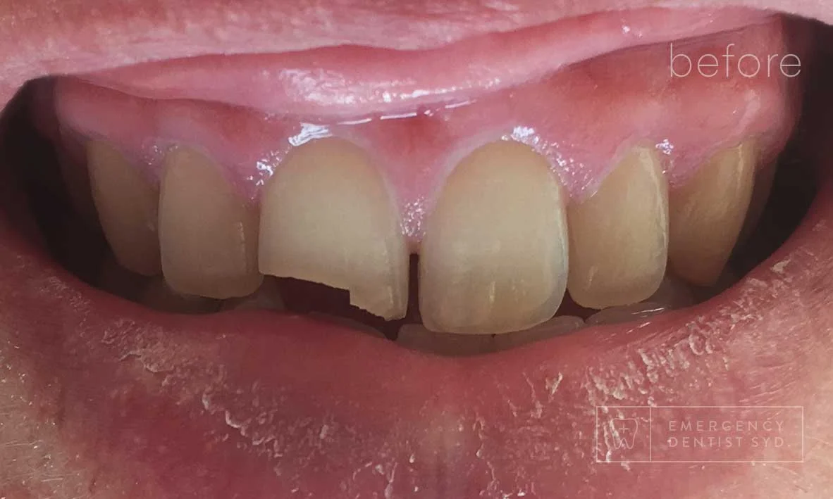Treatment: Dental Bonding