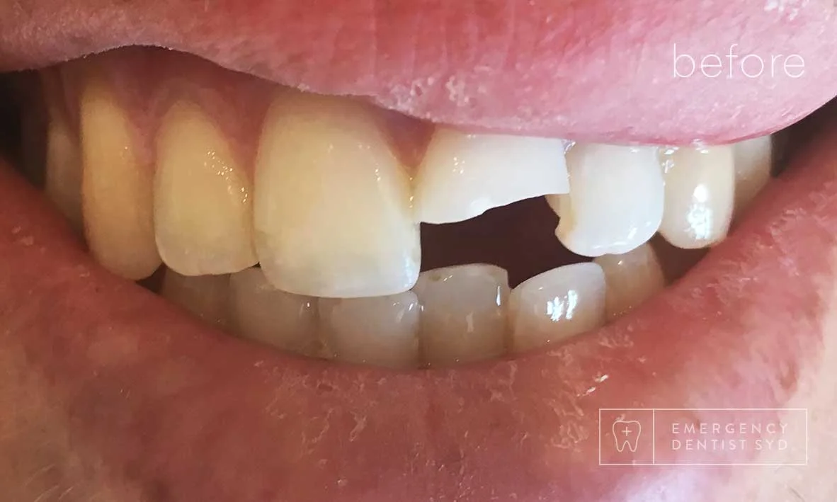 Treatment: Dental Bonding