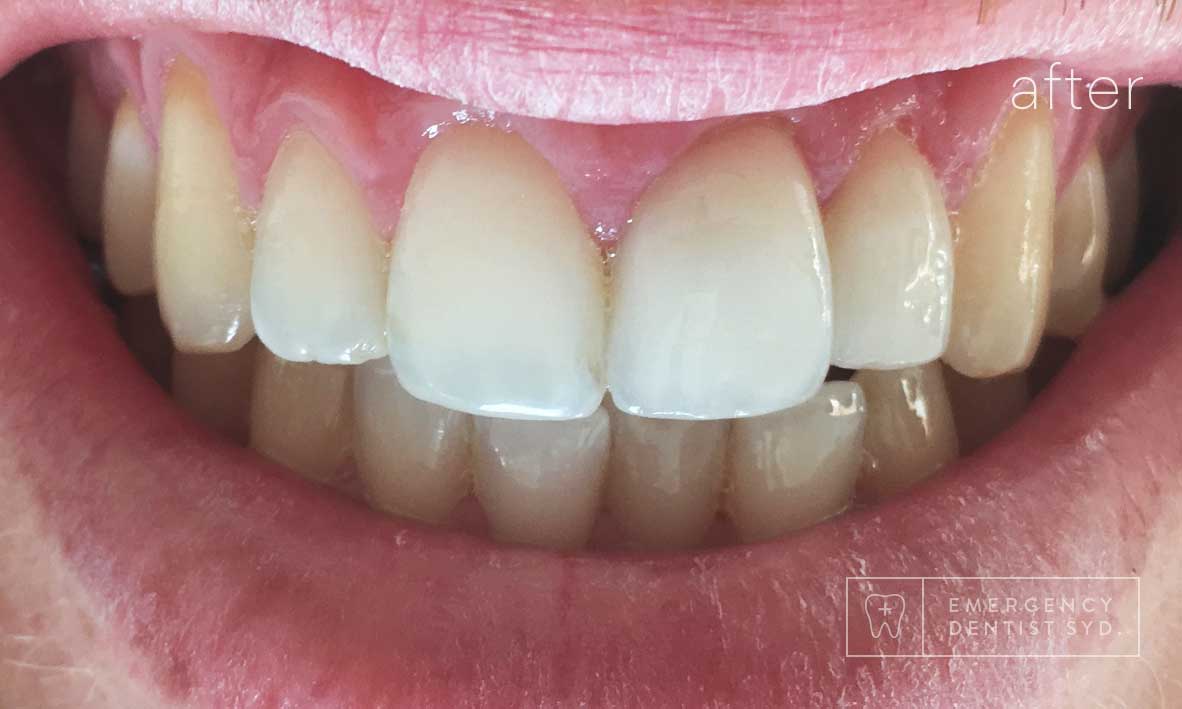 Treatment: Dental Bonding
