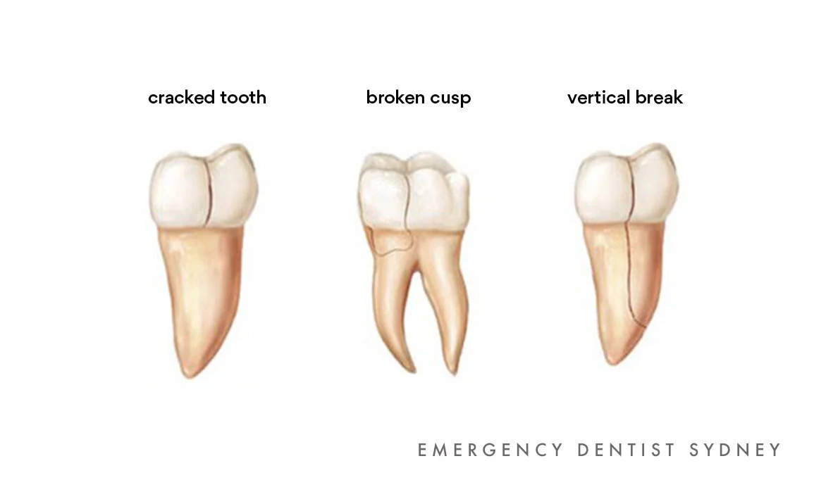 What Does a Dental Emergency Look Like? — EMERGENCY DENTIST SYDNEY