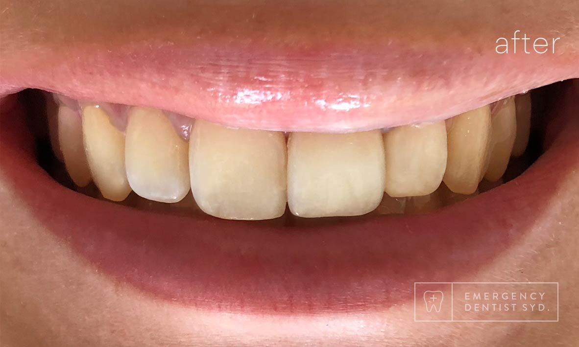 © Emergency Dentist Sydney Smile Gallery Before and After Teeth 11-After.jpg
