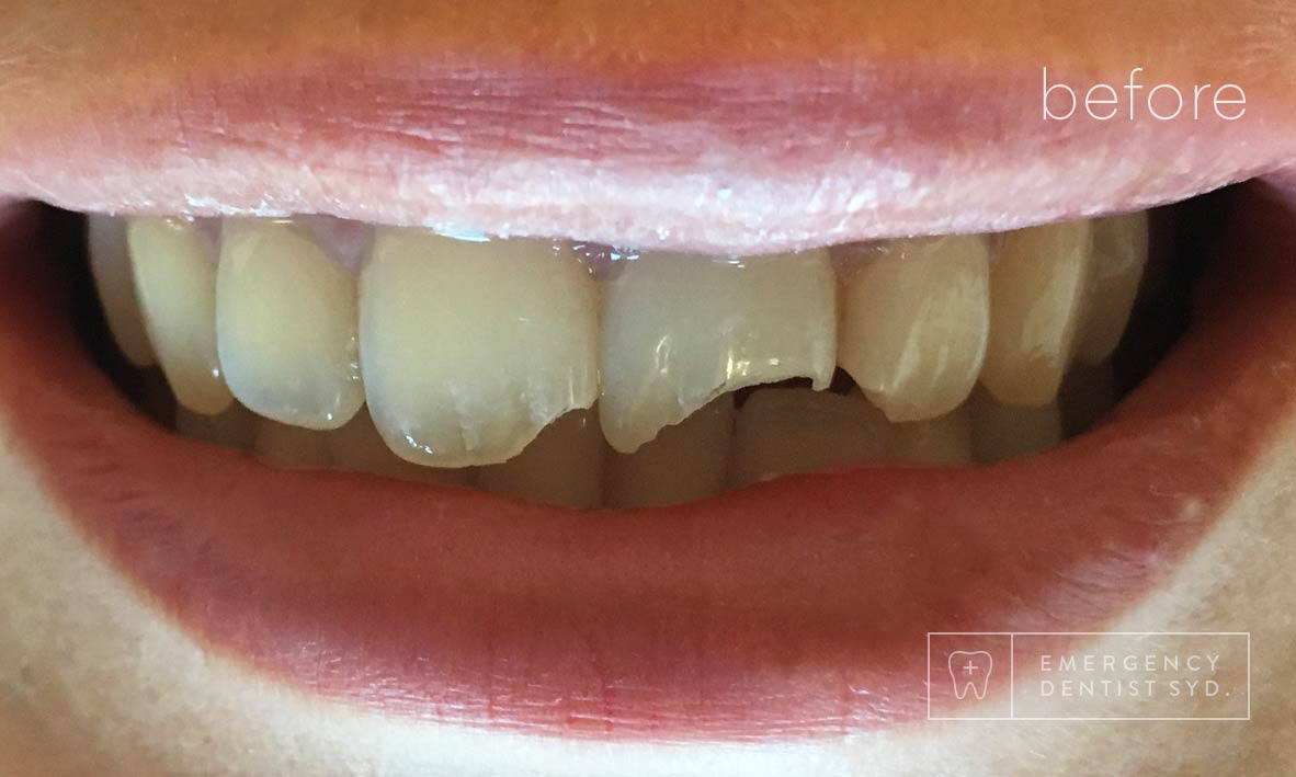 © Emergency Dentist Sydney Smile Gallery Before and After Teeth 11-Before.jpg