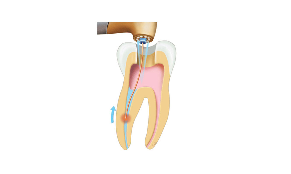 Laser Root Canal Treatment — Emergency Dentist Sydney