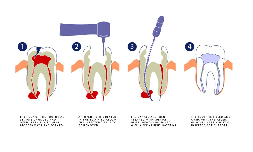 What is an Emergency Root Canal?