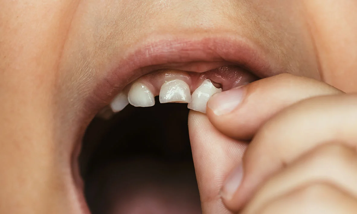 Your Child’s First Lost Tooth