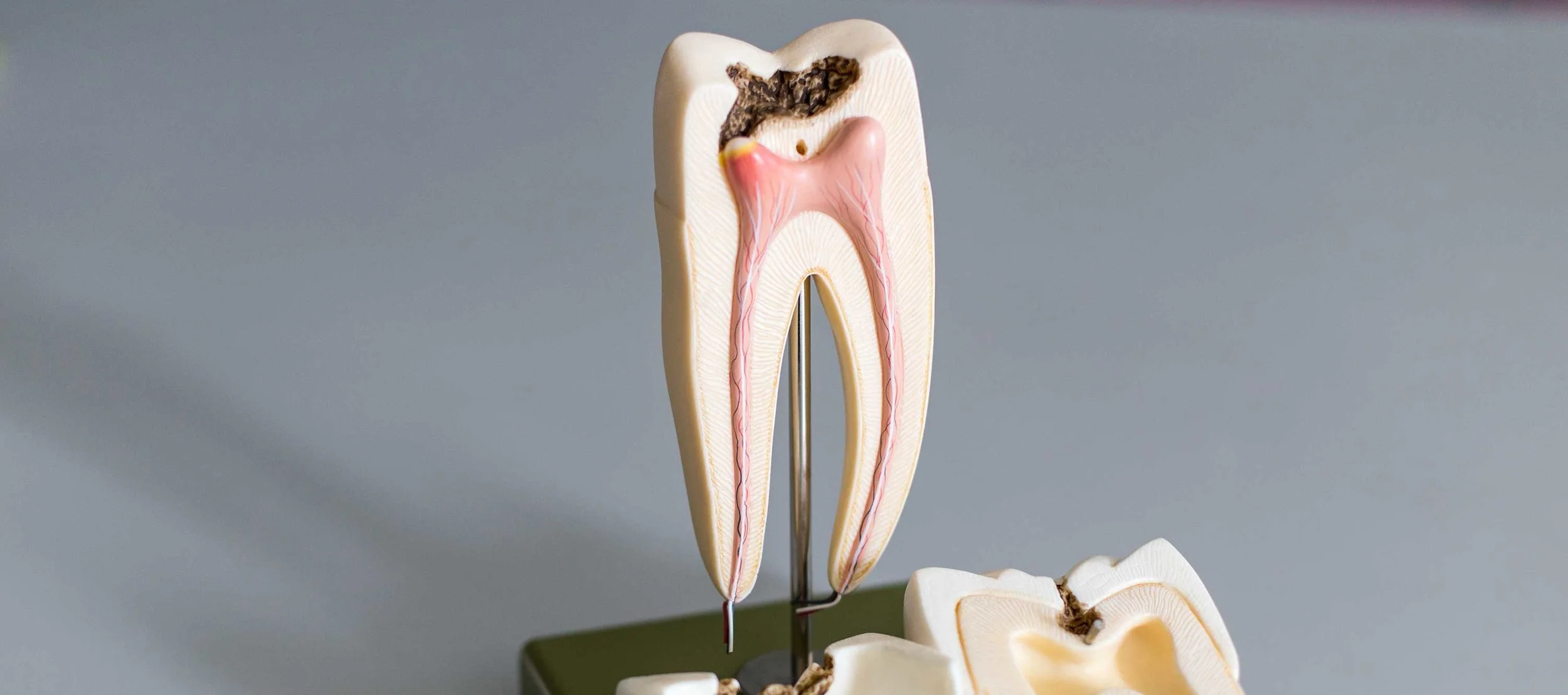 Symptoms Of A Damaged Root Canal To Watch Out For
