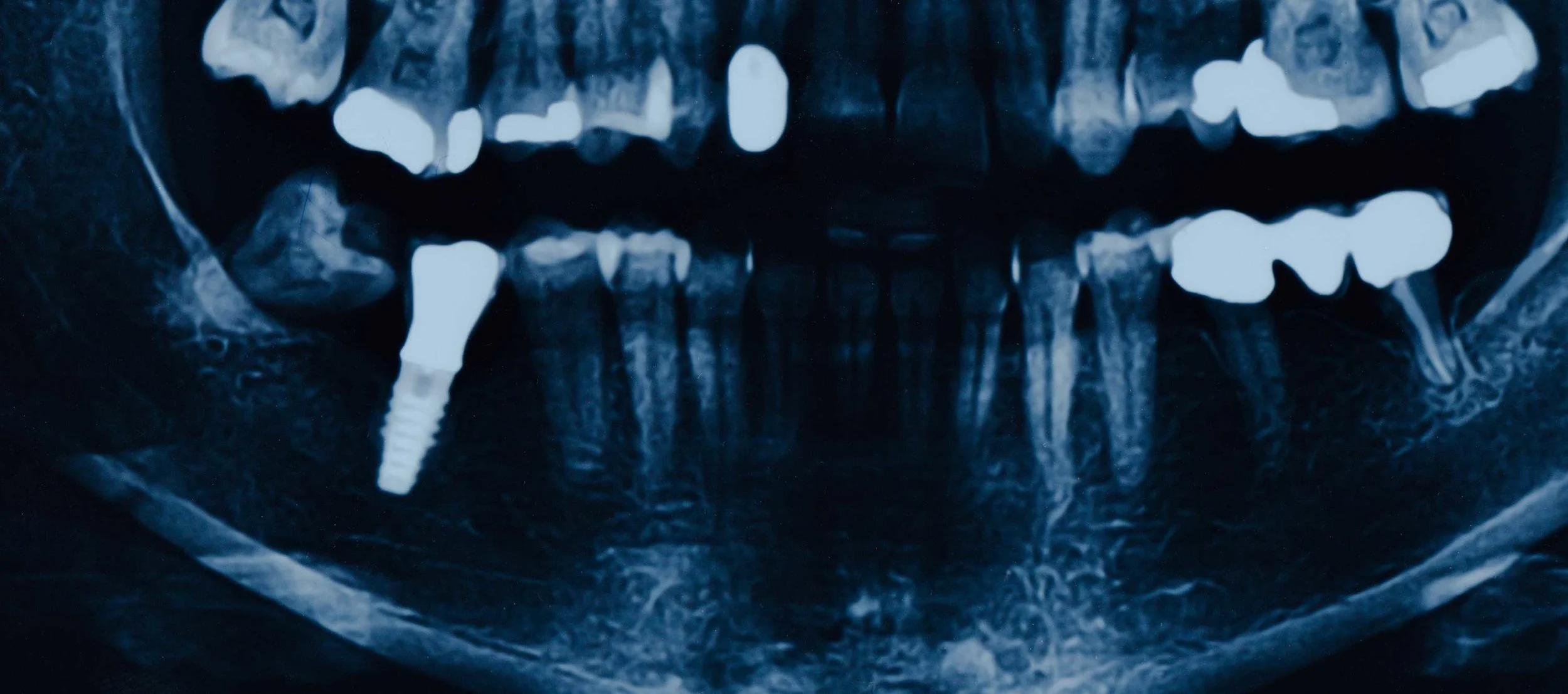 Why Dental Implants Are The Best Option for Missing Teeth
