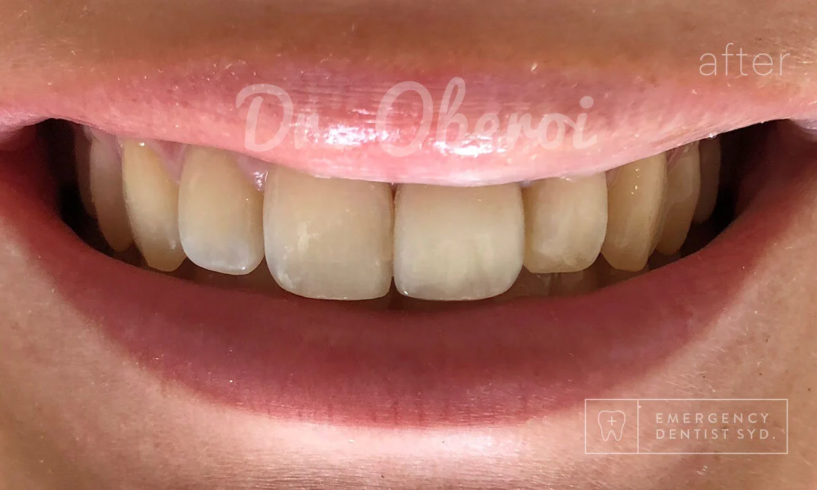 Treatment: Porcelain Veneers