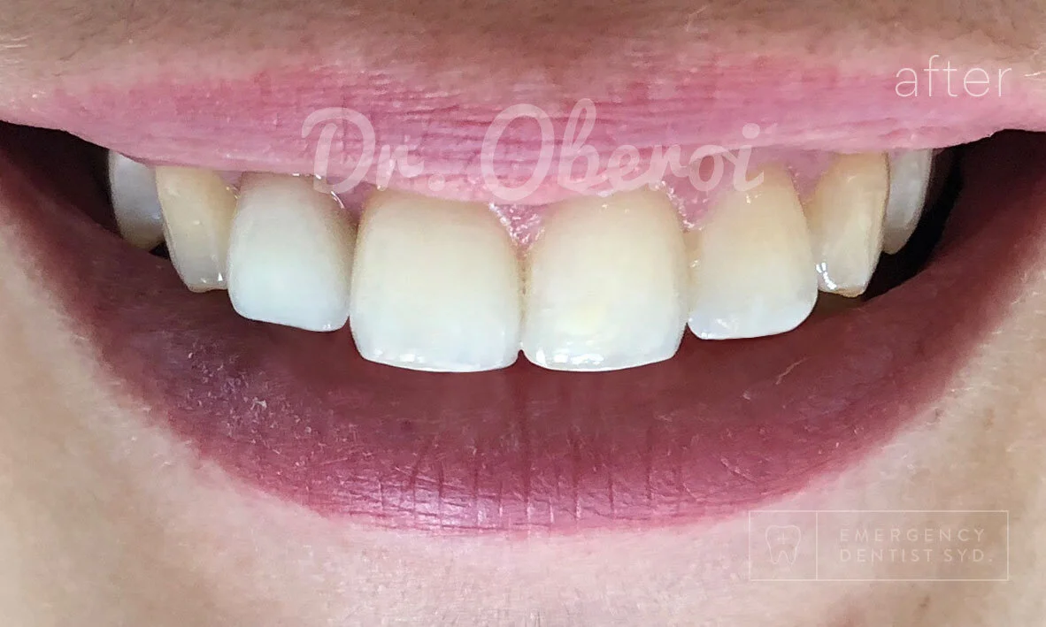 Treatment: Ceramic Veneers