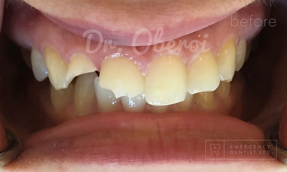 Treatment: Ceramic Veneers