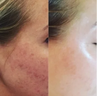 BEFORE AFTER Our Client one week after her very first photo facial to remove red and dark pigment. Three treatments every four weeks is recommended for optimal results.
