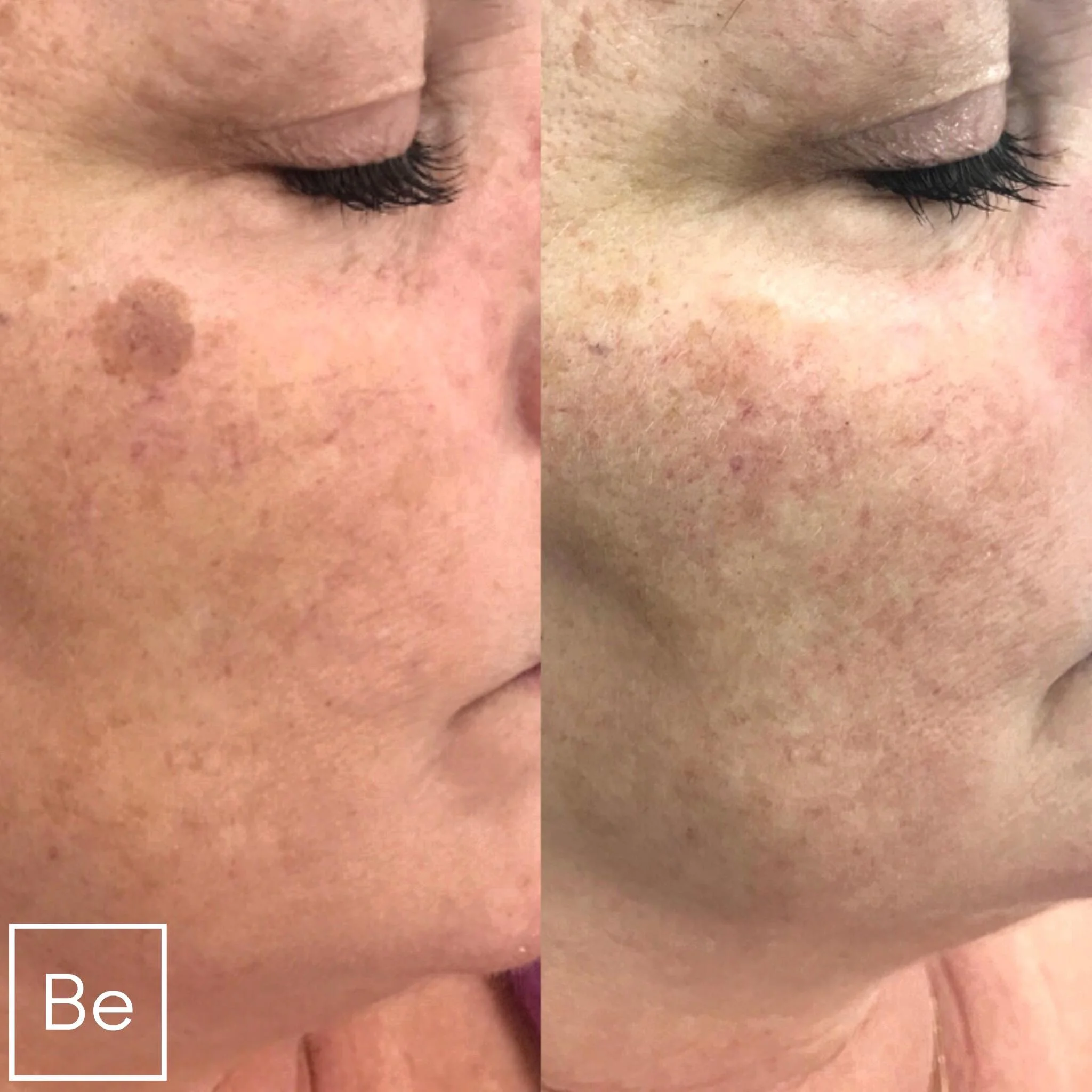 Sun Spot And Age Spot Removal In Rochester NY Bare Element