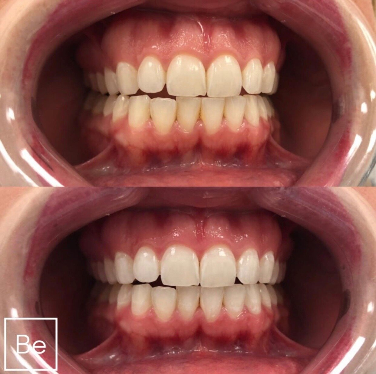 Teeth Whitening Charlestown (#1 Best Bleaching Treatment)