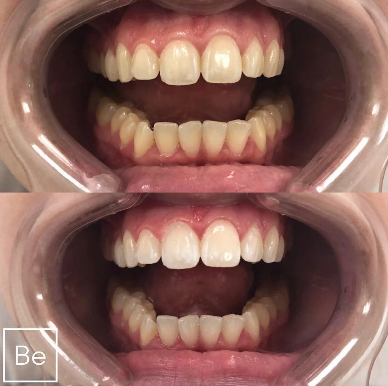 Professional Teeth Whitening Bare Element