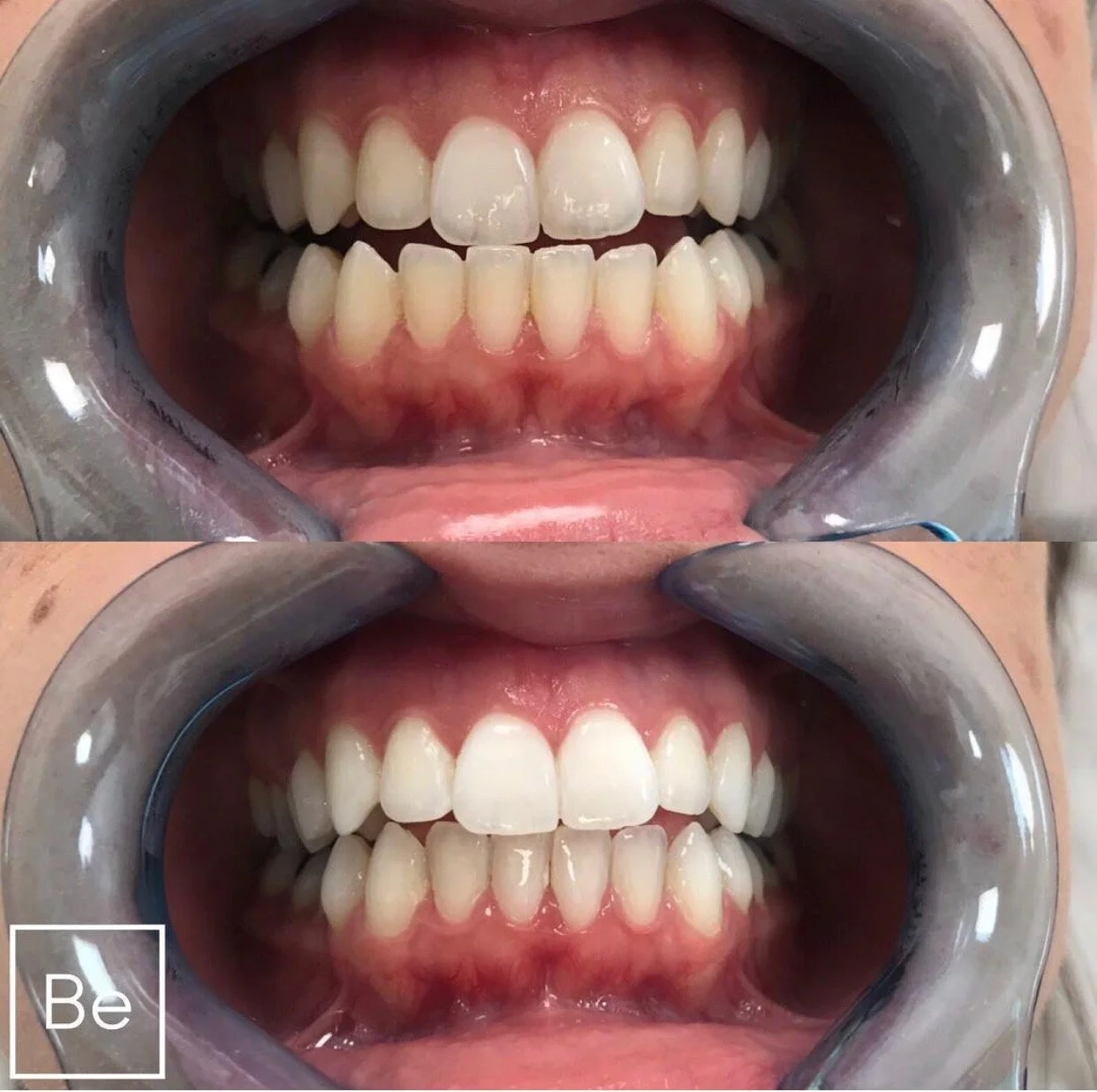 FDAApproved Teeth Whitening Solutions Rochester NY Bare Element